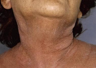 Exfoliative dermatitis close-up view showing eryth