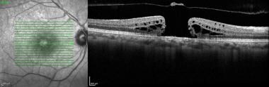 SD-OCT image of a large macular hole. Note its siz