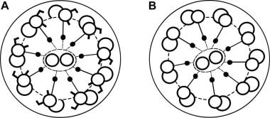 Normal cilia (A) compared with cilia in Kartagener