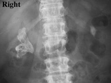 Struvite and staghorn calculi. Plain abdominal rad