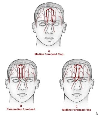 A is a median forehead flap over the forehead vasc