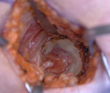Minimally invasive total hip arthroplasty: direct