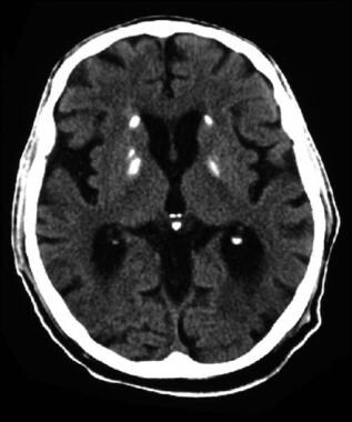 CT scan of a man who has Down syndrome confirmed b