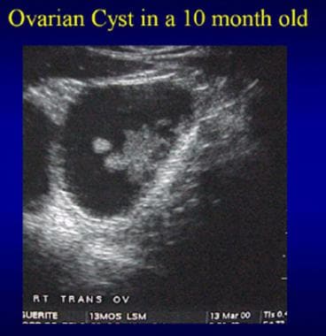 Ultrasound of an ovarian cyst in a 10-month-old gi