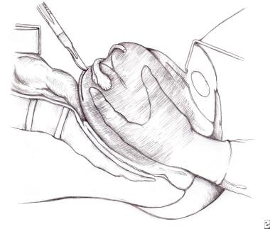Uterine inversion. Image depicts the technique of 