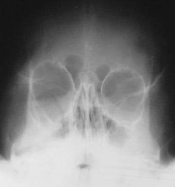 Frontal skull radiograph in a patient with NF1 sho