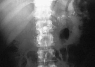 Chronic pancreatitis. Plain abdominal radiograph s