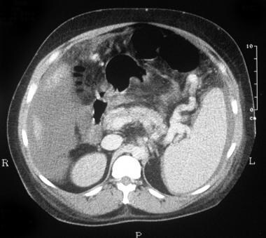 CT scan through the spleen of a 43-year-old man wi