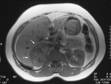 Axial gradient-recalled magnetic resonance angiogr