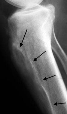 Lateral coned down radiograph of the tibia reveals