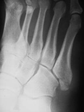 Fractured metatarsals. Comminuted fracture of the 