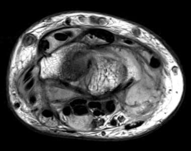 Axial proton-density weighted MR image at the leve
