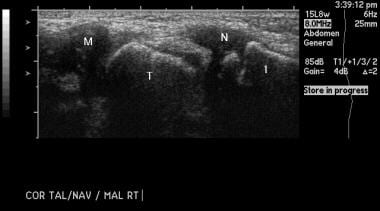 Clubfoot. Sonogram of the medial aspect of a norma