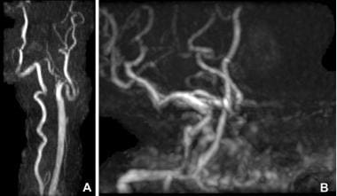 Magnetic resonance angiogram (MRA) demonstrates co
