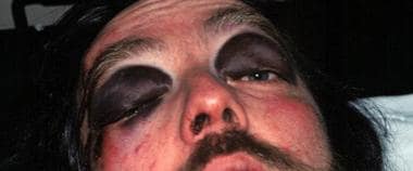 Periorbital ecchymosis, or "raccoon eyes," is a cl