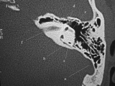 CT scan, temporal bone. The sigmoid sinus indents 