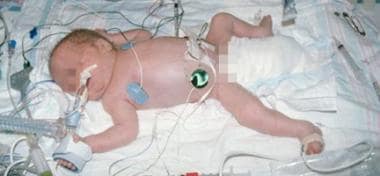 An ill preterm infant, such as this patient, requi