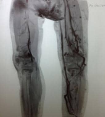 3D CT reconstruction of lower extremities in a pat