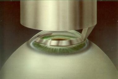 Rotation of the dissector creates the tunnel in th