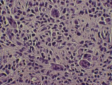 High-power photomicrograph of giant cell tumor of