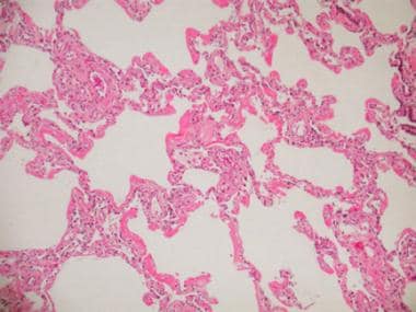 Acute respiratory distress syndrome (ARDS), common