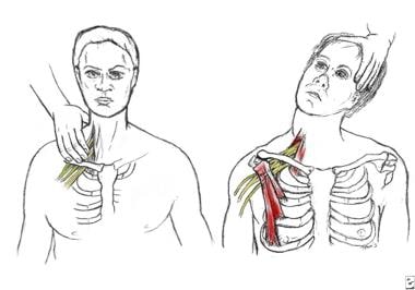 Scalene focal (left) and regional (right) stress t