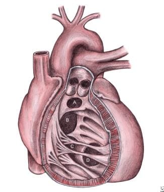 Ventricular Septal Defects. Schematic representati