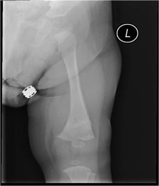 Healing distal femur buckle fracture at 2-week fol