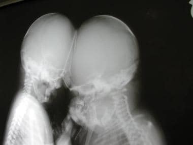 A radiograph of the skull, showing the conjoined h