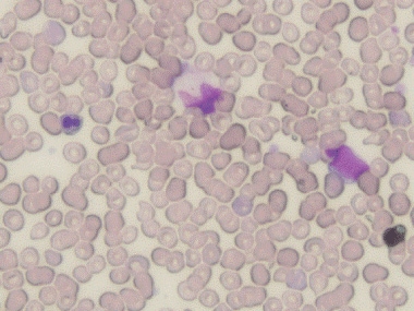 A dysplastic red blood cell with budding nuclei (l