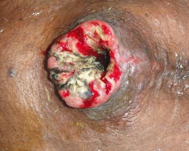 Postoperative malignant enterocutaneous fistula. 