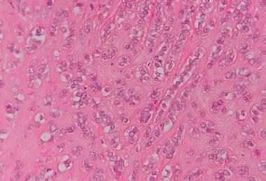 Sclerosing Sertoli cell tumor retains cord arrange