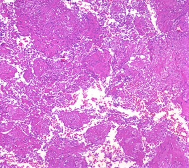 Medium-power photomicrograph demonstrates secondar