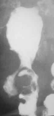 Crohn disease. Single-contrast barium enema study
