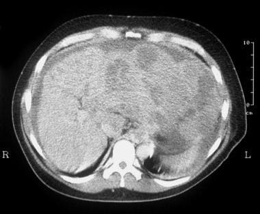 CT scan through the liver (same patient as in the 