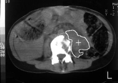 von Hippel-Lindau syndrome. Axial CT scan through 