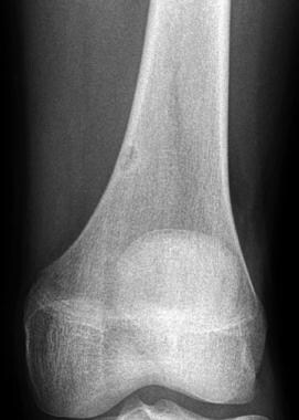 Anteroposterior radiograph of the distal femur sho