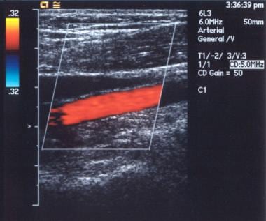 Color Doppler sonogram of the popliteal artery. Th