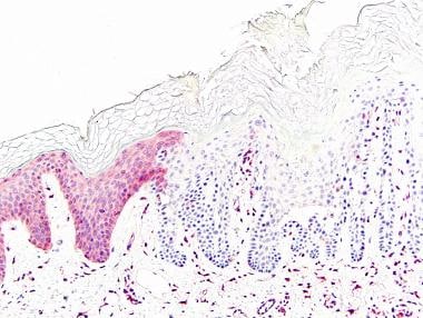 Absence of sarco/endoplasmic reticulum Ca2+ ATPase