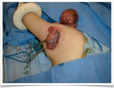 Surgical photograph during resection of axillary m