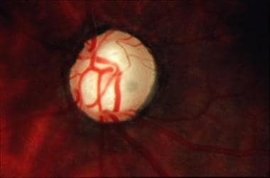 Cupping of the optic disc in late glaucoma. 