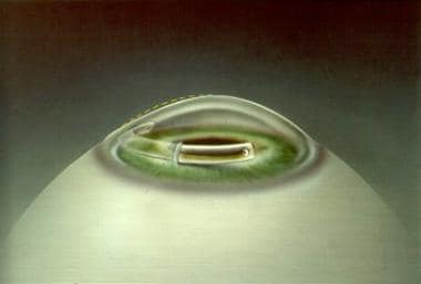 The first Intacs insert is placed in the tunnel. R