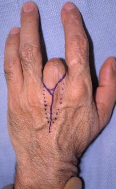 In performing a central ray amputation, the dorsal