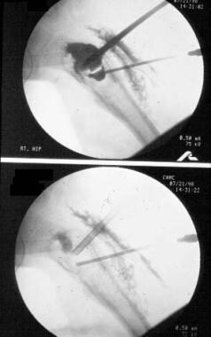 Double-cannula technique demonstrates intraoperati