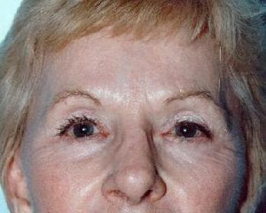 Postoperative view (2 y), endoscopic brow lift sur