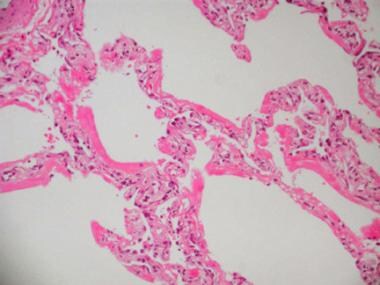 Acute respiratory distress syndrome (ARDS), common