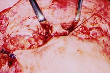 The sutures seen in this figure each are attached