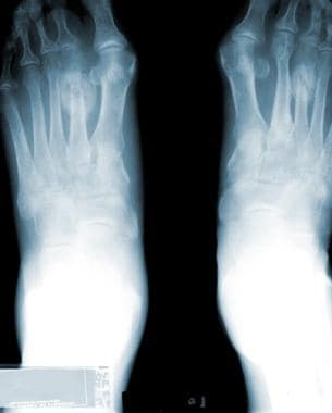 Radiograph of the feet. This image depicts a stres