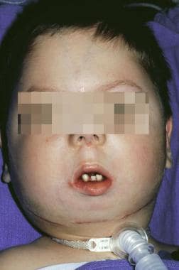 Child with craniofacial anomalies and microstomia.