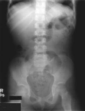 Plain abdominal radiograph that demonstrates stool